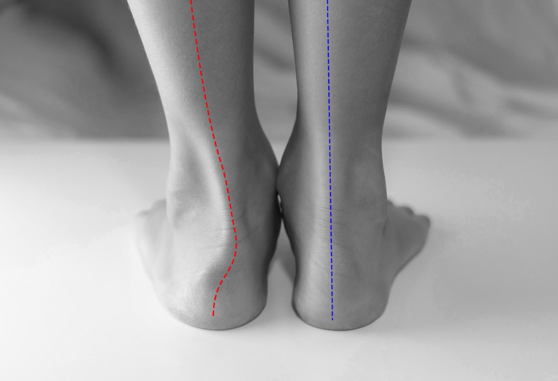 Back view of two feet showing a comparison between an overpronated foot with a curved alignment line and a neutral foot with a straight alignment line.